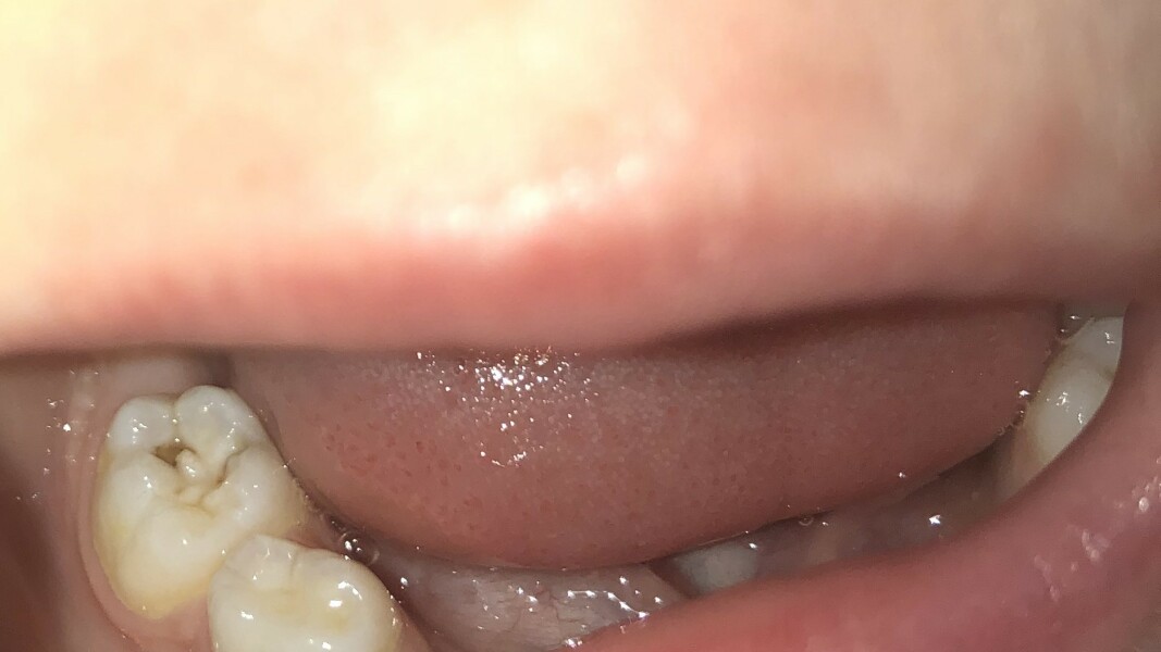 Toddler molar problem potentially