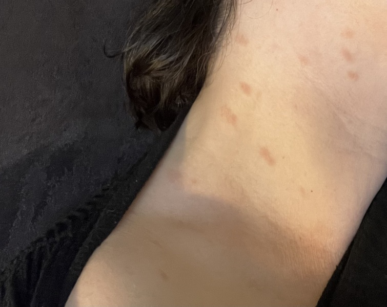 Dry rash photo - what is this?