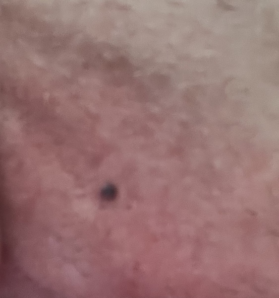 Black ‘spots’ on labia minora 