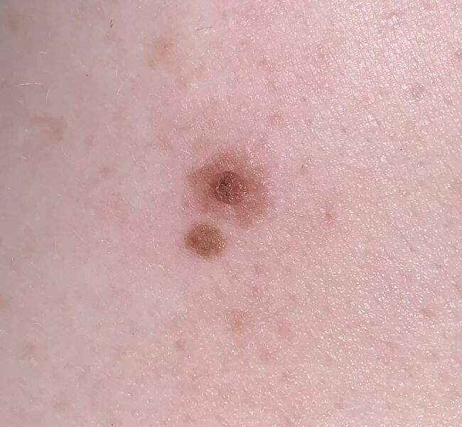 Does this look like skin cancer