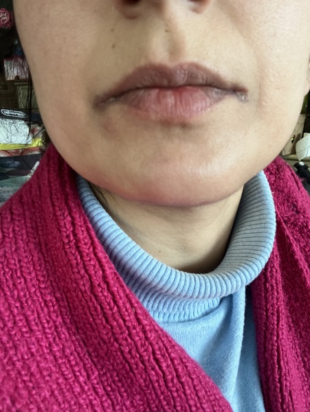 Sores on mouth - pic