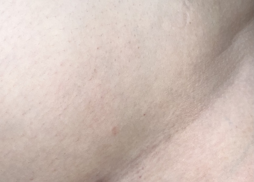 Is this melanoma?? Handhold needed