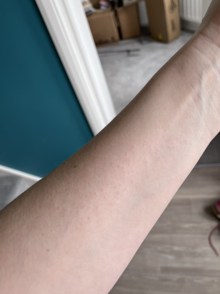 Does this look like dermatitis herpetiformis?