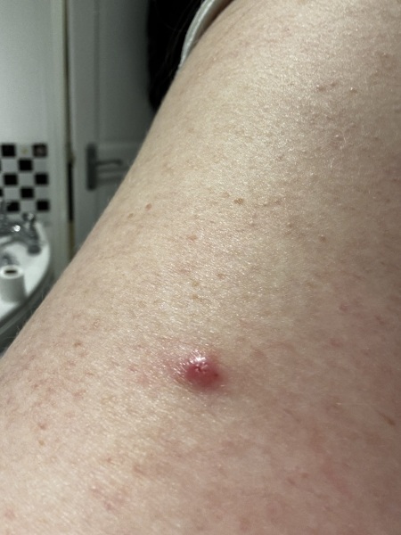 Basal cell carcinoma? Any dermatologists? Help!