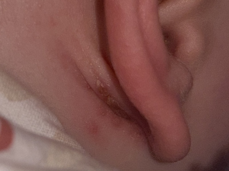 Scabby/ weeping behind ear