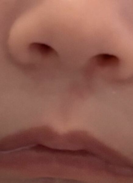 Mark under baby’s nose since birth?