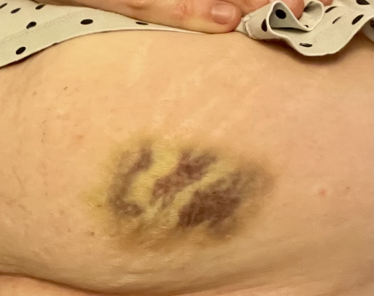 Injection site bruising