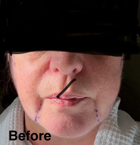 Having facelift surgery in 10 days - support and advice needed