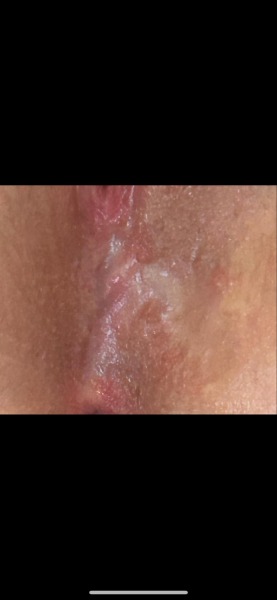 Third degree tear scar pain (TW)