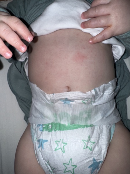 Is this chicken pox? (Pic attached)