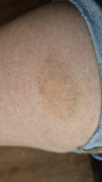 Injections now hurting and bruising