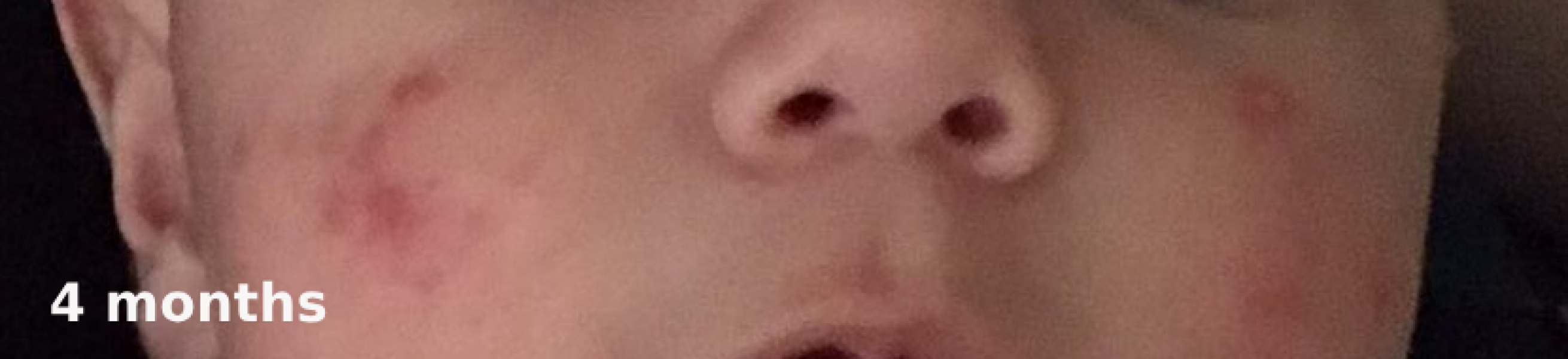 Infantile Acne / Baby Acne at 5 months