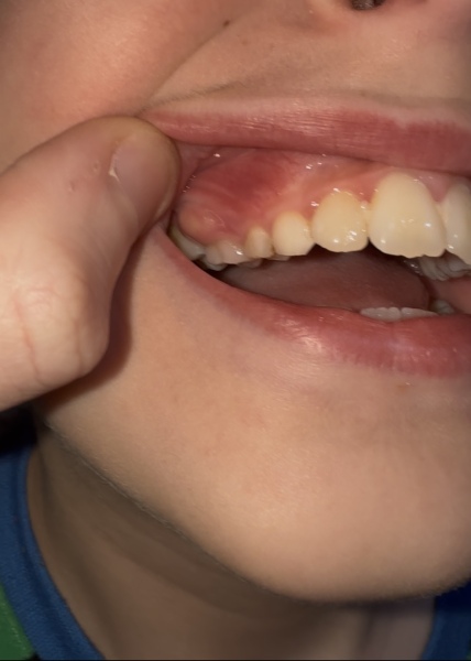 Is this an abscess on my sons gum?