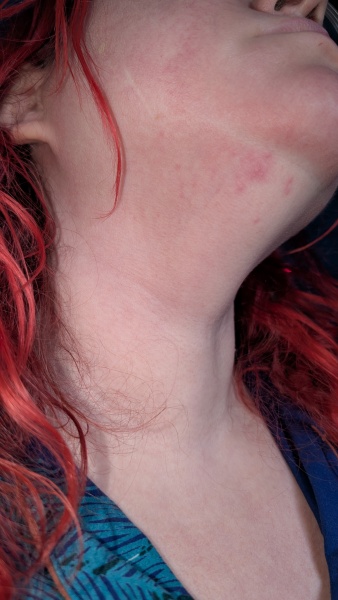 Shingles?