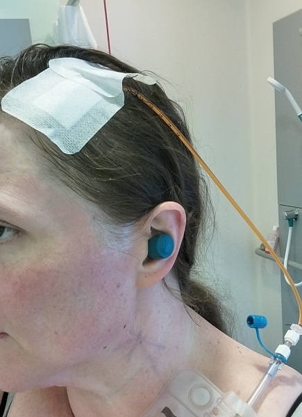 Psst, wanna see what a neurosurgeon drained out of my brain?