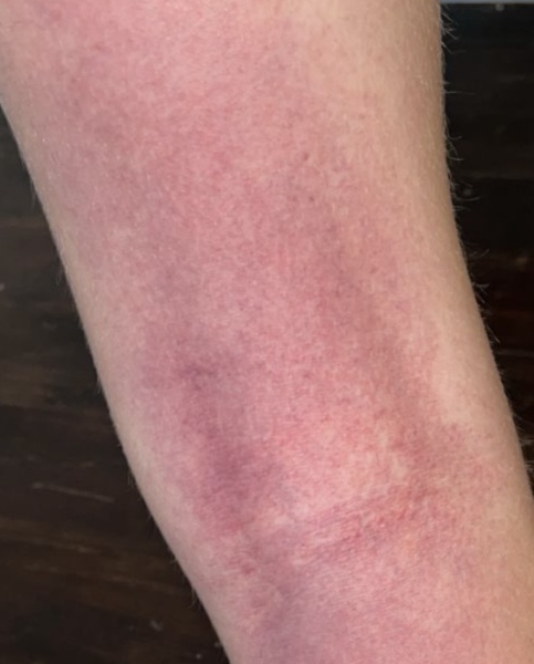 To present to ED with 13yr old rash.