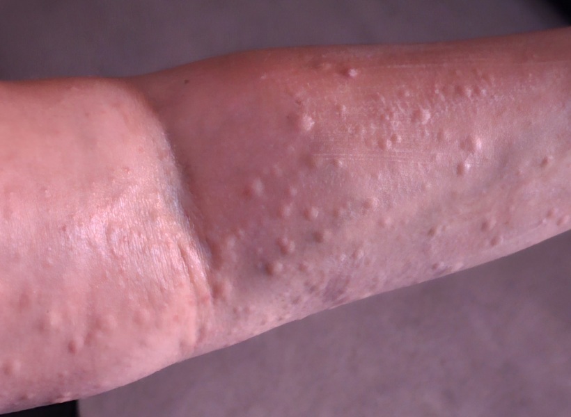 Rashes are driving me to insanity