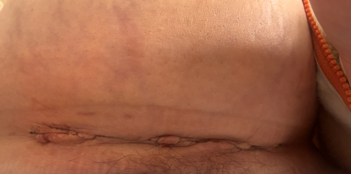 Botched csection?