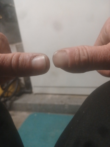 Help me with my manky thumb please!