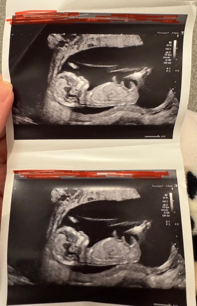 Any guesses on 🩵 or 🩷? 13+6 weeks.