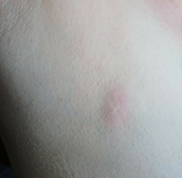 To ask if you or anyone you know had a breast lump that changed to sore and red?