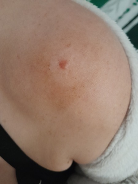 Mole worry