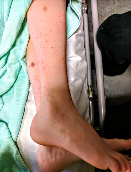 To present to ED with 13yr old rash.