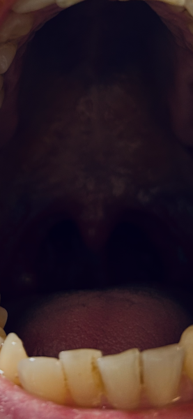 Strep Throat
