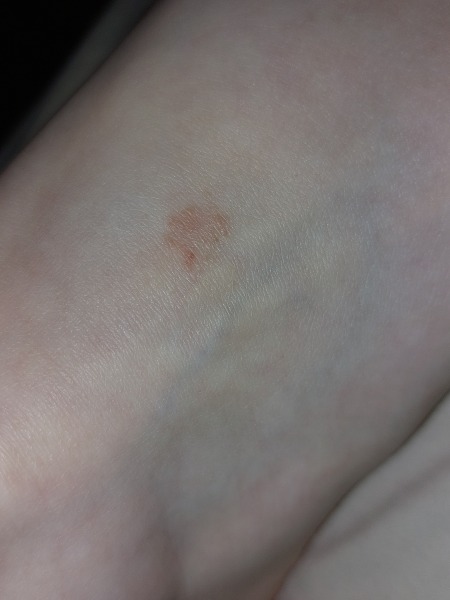 Is this athlete's foot? Eczema?
