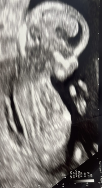 Gender prediction boy or girl 12w?