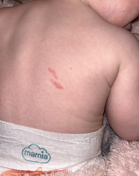 Please anyone any advice on  a rash on my babies back