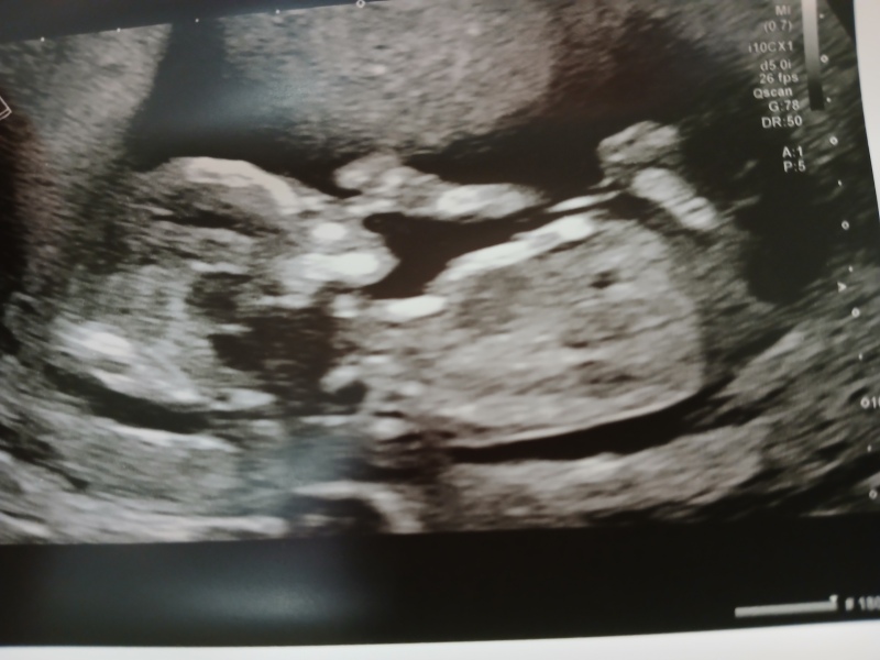 Nub/skull theory at 14 weeks