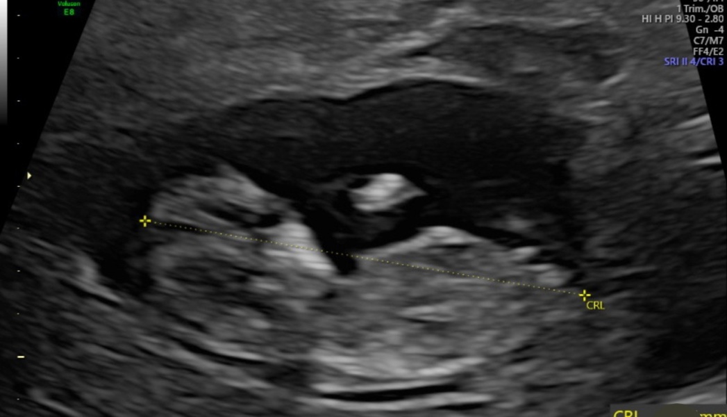 Nub theory- boy or girl?