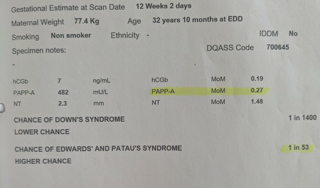 NHS screening results 1 in 56 for Edwards and Patau Syndrome