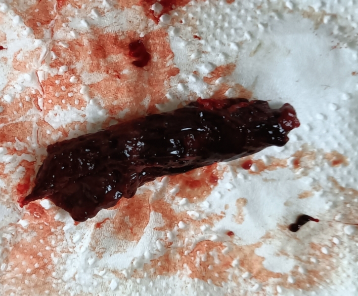 Clots/Tissue/Menorrhagia????