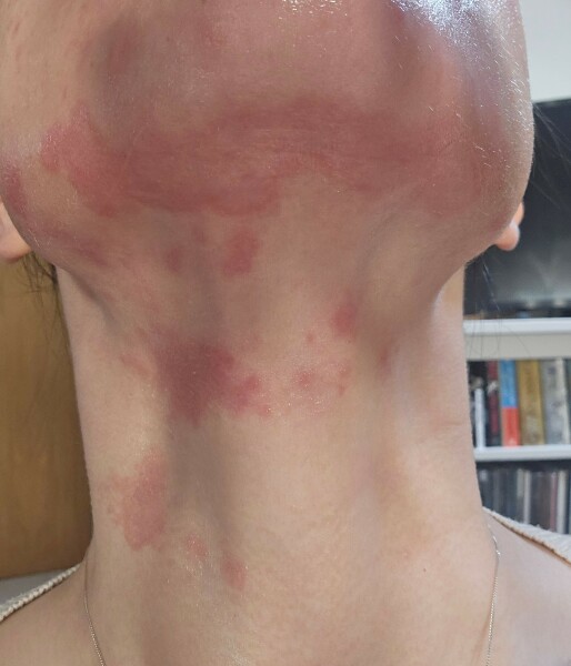 Neck rash - help!