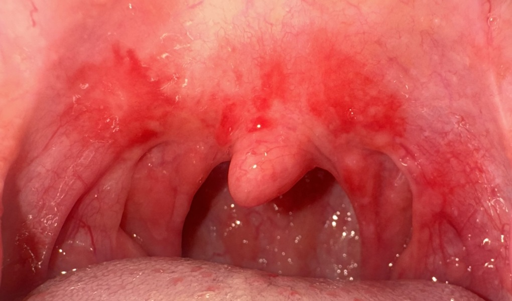 Throat - photo attached