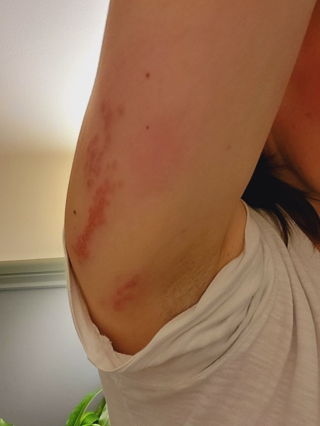 Shingles?