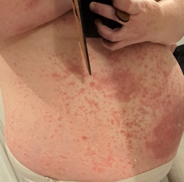 Pupps or scabies?!! Help!
