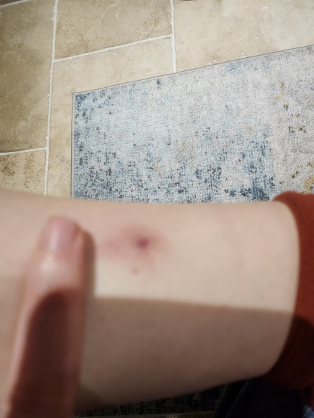 Does this look like a tick bite?
