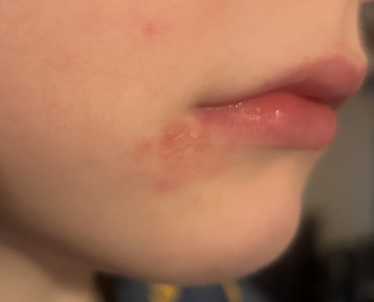 Any ideas on what this is on my son’s face?