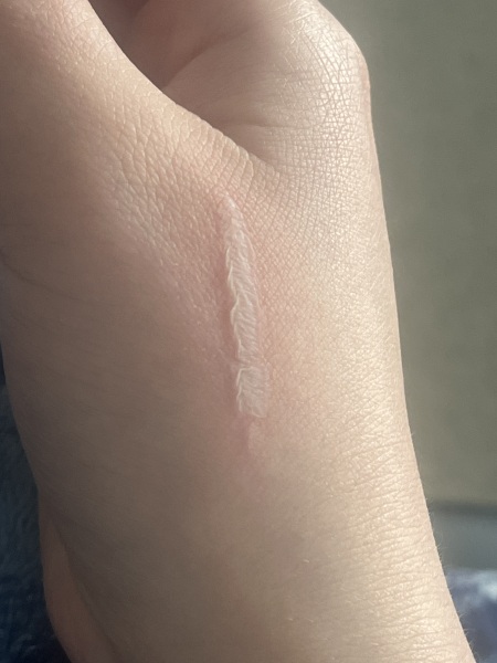 A&E burn