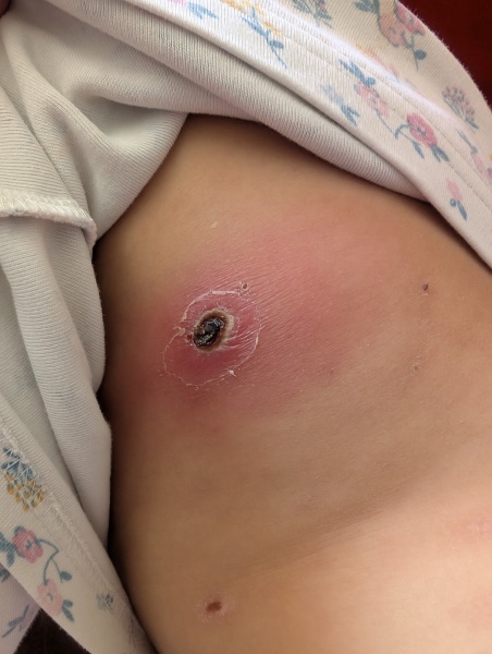 Infected chickenpox help please!