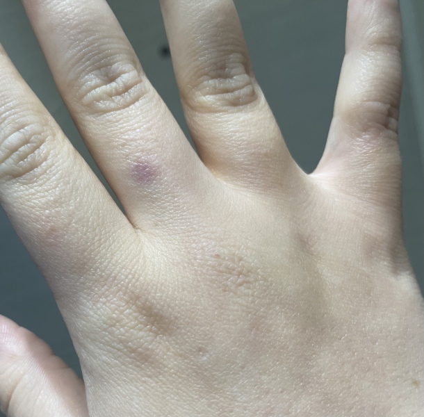 Unusual bruise on finger, no injury