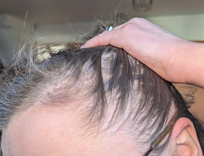 Reasons for hair loss?