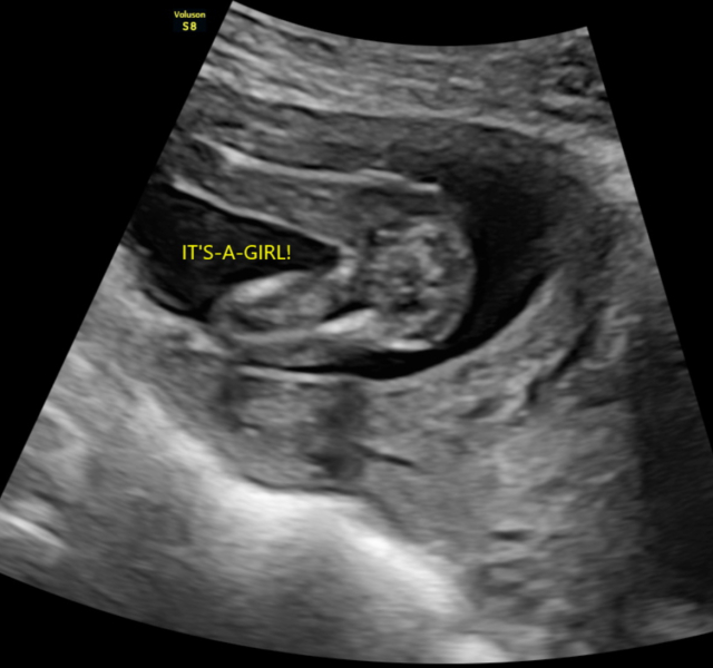 Private Gender Scan Right?