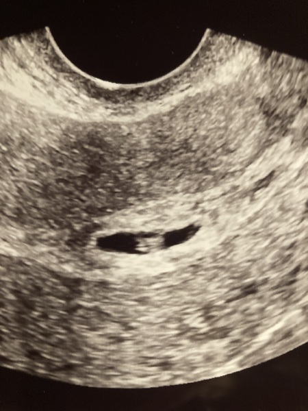 Subchorionic Hematoma