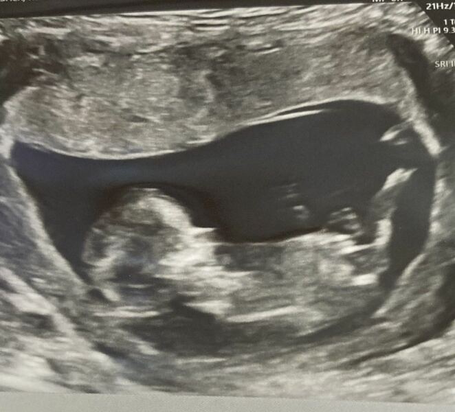 Gender of baby
