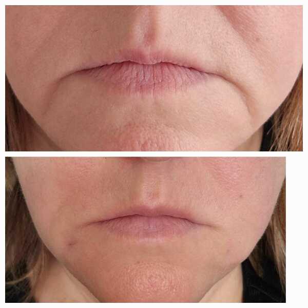 Had filler yesterday...
