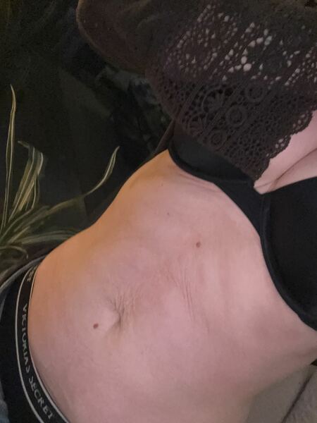 Has anyone found something to help loose skin on the stomach that doesn’t involve surgical procedure?